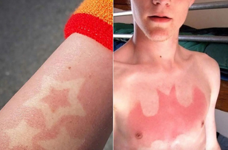 Doctors Warning #SunBurnTattoo Challenge Can Be Extremely Dangerous