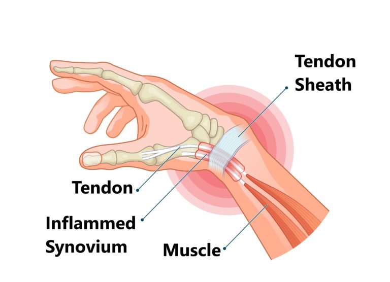 How to Know If You Have a Quervain’s Tendonitis?